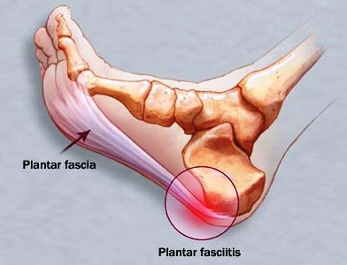 Immagine che rappresenta la fascia plantare, punto d'infiammazione e dove si può formare uno sperone calcaneare