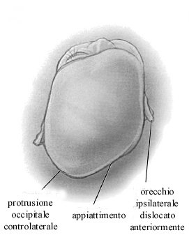 Forma classica a paralellogrammo che assume la testa da plagiocefalia da posizione nel neonato